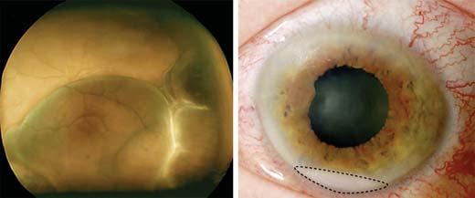 Fig. 1. Fundus photo of the ptient s left eye (cse 1) shows n inferior serous retinl detchment with choroidl thickening nd effusions.