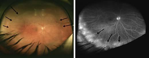 Color version ville online Before rdition After rdition Fig. 2. Fundus photo of the ptient s right eye (cse 2) showing diffuse, irregulr choroidl elevtion nd rre intrretinl hemorrhges.