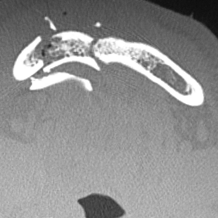 Figure 2a: Coronal CT scan (bone window) showing fracture of the hard palate, bilateral pterygoid plates and comminuted fracture of mandible Figure 1b: Axial CT scan showing (bone window) showing