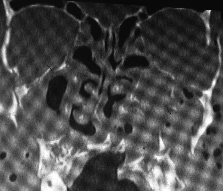 medial and lateral wall of bilateral maxillary sinuses along with fluid collection in maxillary sinuses suggesting hemosinus Figure 1c: Axial CT scan showing (bone window) showing comminuted fracture