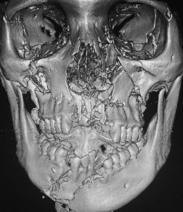 DISCUSSION The facial skeleton is anatomically divided into five different regions: nasal, orbital, zygomatic, maxillary and mandibular.