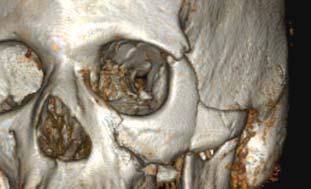 Zygomatic-maxillary Complex