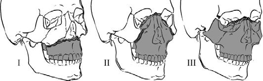 LeFort Fracture Patterns Described as symmetric mid face lines of weakness experimental Often asymmetric clinically and combined with ZMC, NOE Always involves pterygoid