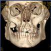 (Serves a Population of 3 Million) Mandible fractures represented 45% of all Facial Fractures Treated