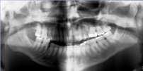 Fractures Frontal Sinus Frontal Sinus Zygoma (ZMC) Orbital Floor Nasal Orbital Ethmoid Nasal Maxilla Mandible Anatomy-