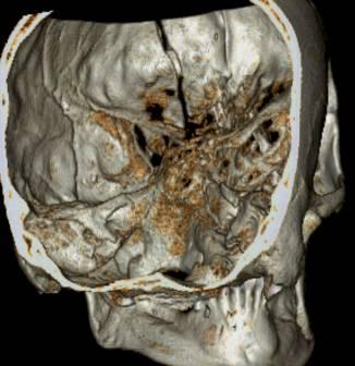 Zygomatic-maxillary