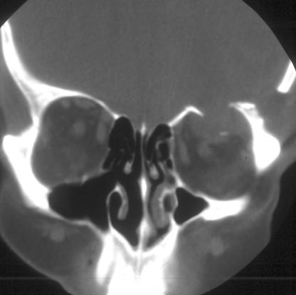 Orbital Blow-in fracture: MRI with brain