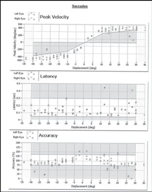 FIGURE 2. Saccade test results demonstrating normal function. revealed bilaterally normal tympanograms; however, the patient became dizzy during testing on the right side.