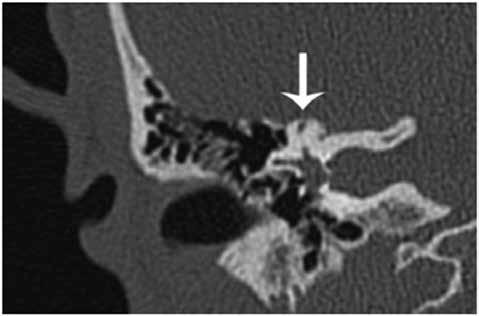 The results of the scan showed a small opening, or dehiscence, on the superior portion of the superior semicircular canal (FIGURE 9). This was diagnosed to be the cause of the patient s symptoms.