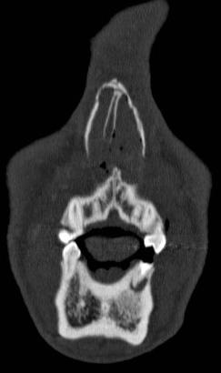Isolated Nasal Fracture: Case 1 Bilateral