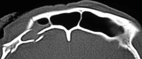 with posterior wall fractures (AJNR 1992; 13(3):897-902) Associated