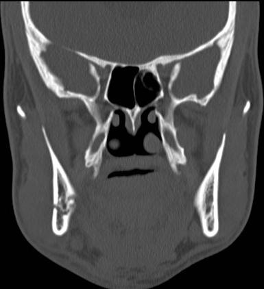 Mandibular Fractures Pretzel-bagel spectrum Condylar neck/ body fractures are most