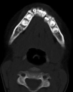 Mandibular Fractures: Case 1