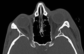 Zygomatico-Maxillary Complex: Case 1 26 Y/M s/p trauma Surgical