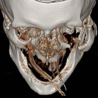 Craniofacial dissociation Fractures of