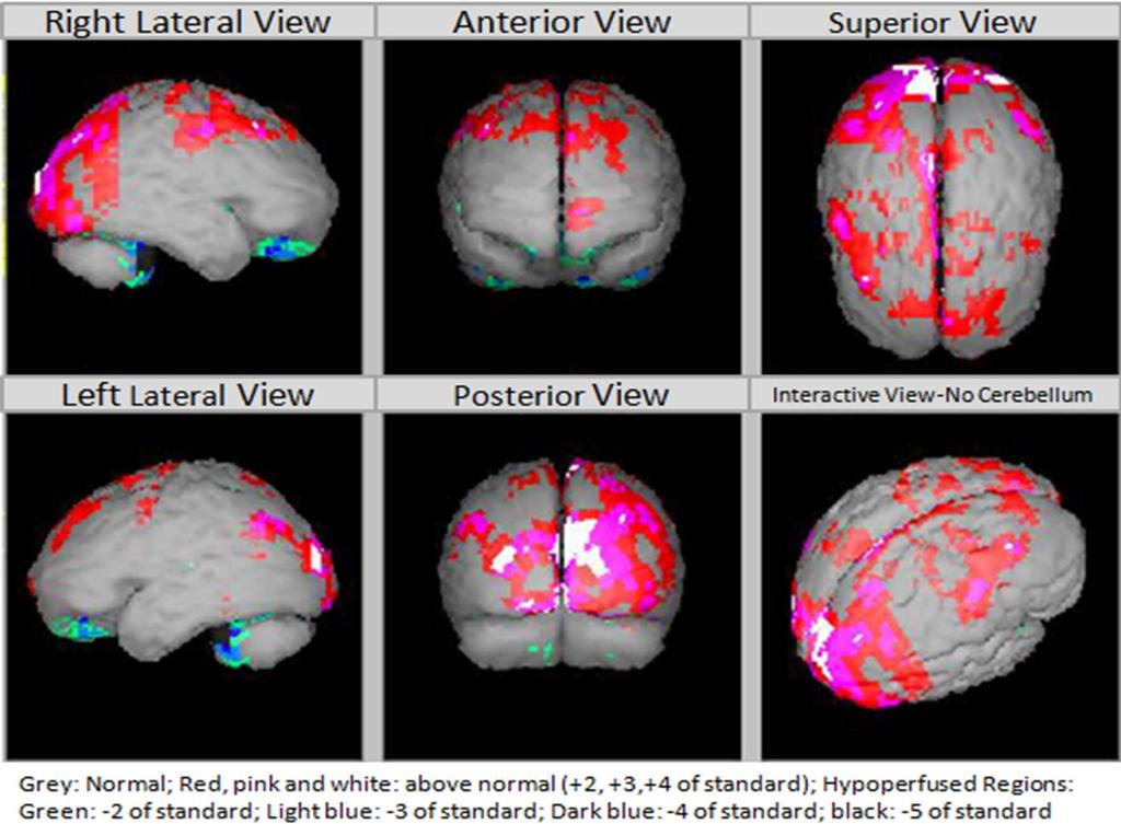 SPECT AFTER TREATMENT (20 NOV 2014) Normal hypoperfusion in the cerebral region and a
