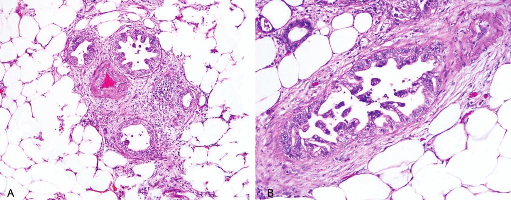 Figure 6. A, Malignant ducts are located next to a thick-walled, medium-caliber vessel and are diagnostic of adenocarcinoma, despite their bland appearance.