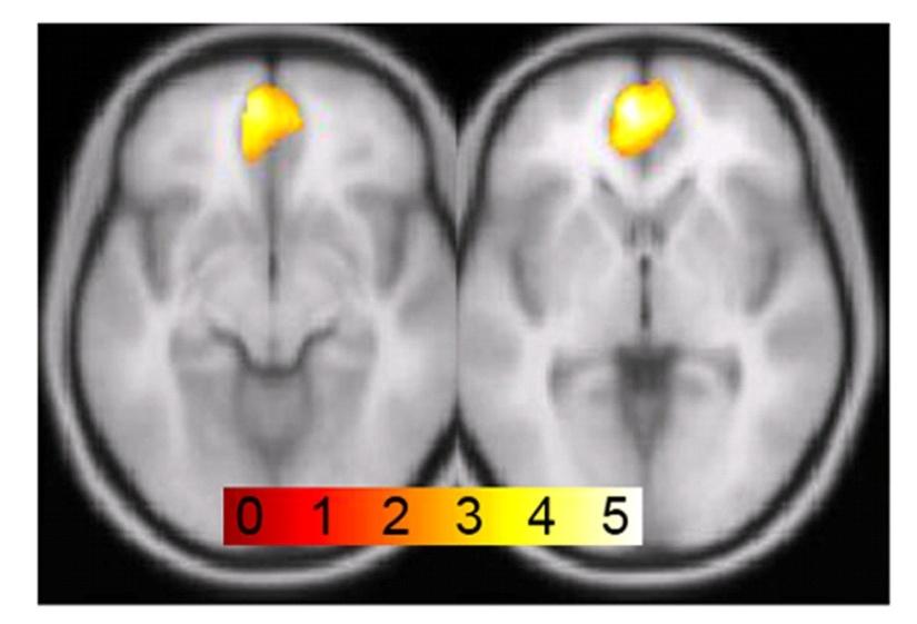 Brain changes are persistent Last drug use (2 yrs) GM volume (5, 53, -3)