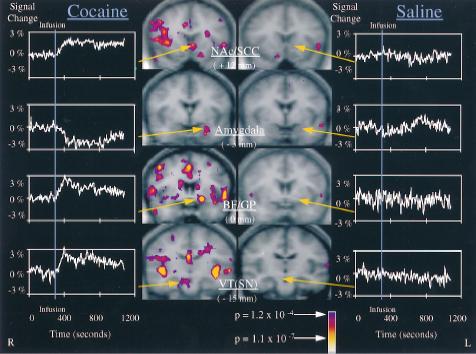 Mesolimbic pathway is activated by cocaine in humans