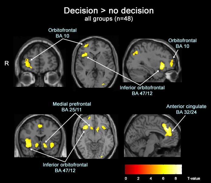 Brain activity during decision-making on modified IGT Anterior Cingulate Attention conflict