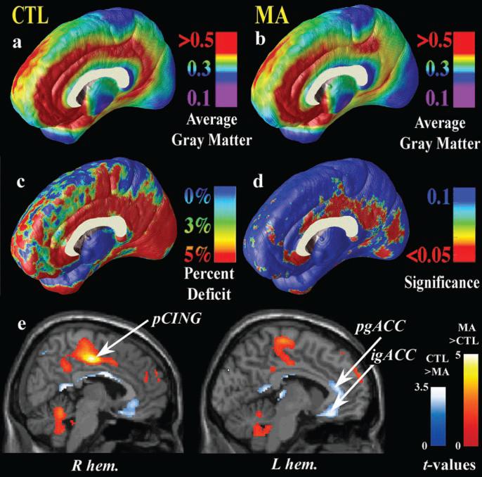 GM infragenual and posterior CG Chronic MA a selective pattern of cerebral deterioration with