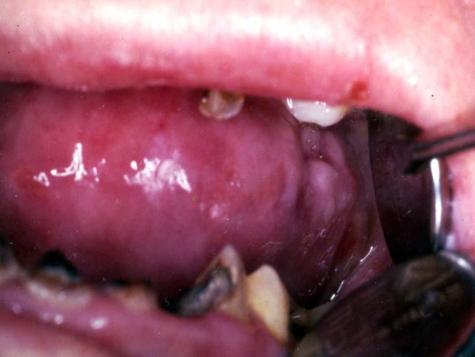 Oral lesions Figure 4.