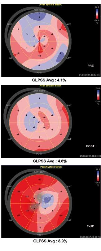 254 Chapter 16 Figure 1. Changes in global LV longitudinal strain after CRT device implantation. Example of a 17-segment bull s eye display of the LV of a responder to CRT.