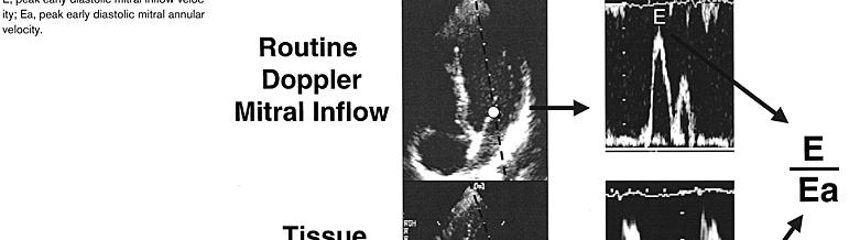 Tissue Doppler Imaging Assessment of LV Diastolic Function Magnitude of Ea