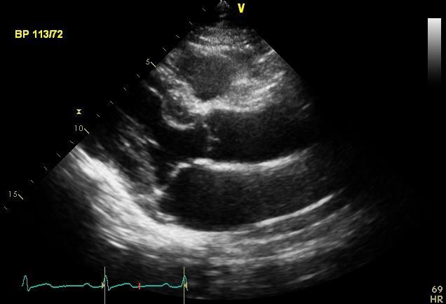 Functional assessment of LV End diastole : first frame after mitral valve closure frame with the largest LV dimension or