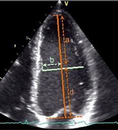 Echocardiographic assessment of LV mass Good Partial correction for shape distortions Less