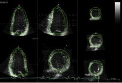 Echocardiographic assessment of LV mass 3D based formula Good Direct measure without geometrical assumptions More