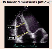 Echocardiographic assessment of RV size RV linear dimension (inflow) RV linear dimension (outflow) Good Bad Good Bad Fast, widely used Published data Simple Fairly