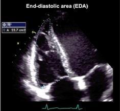 Echocardiographic assessment of RV size RV areas (inflow) 3DE RV volumes Good Bad Good Bad
