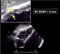 Echocardiographic assessment of RV size RV wall thickenss RV free wall thickness M-mode or 2DE End-disastole Below TV, approximating the length of