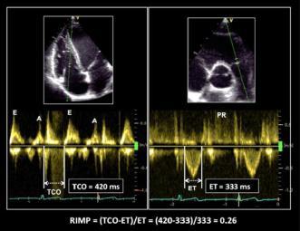 Echocardiographic assessment of RV function RIMP (RV index of myocardial performance) = (TCO-ET)/ET, TCO;