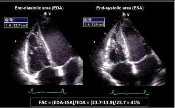 Echocardiographic assessment of RV function RV FAC (%) = 100 x (EDA ESA) / EDA, FAC; fractional area change RVEF (%) =