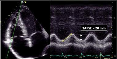 Echocardiographic assessment of RV function RV longitudinal systolic function - TAPSE RV longitudinal