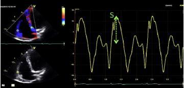 Echocardiographic assessment of RV function RV longitudinal systolic function - Color tissue