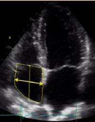 Echocardiographic assessment of RA size Linear dimensions - 2D-guided measurements Area -