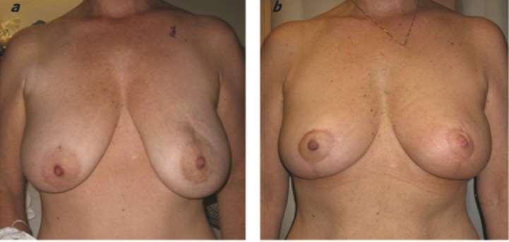 Oncoplastic Reduction Mammoplasty -Use of neoadjuvant chemotherapy -Breast conservation Indications - Minimal Skin Resection or Tumor within Wise Pattern - C-Cup Breast Size with