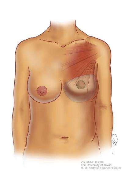 Two-Stage Breast