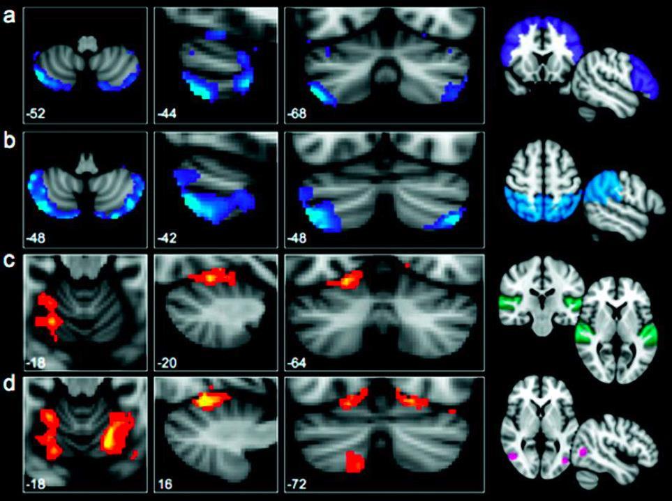 Connectivity of cerebellar non-motor regions Axial Sagittal Coronal Frontal cortex