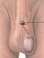 6. Other Intra-Vas Device (IVD) Implant in vas deferens blocks sperm transport. Downside: can irritate the vas deferens. 6.