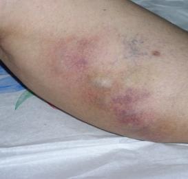 sclerotherapy to evacuate If accompanied by inflammation,