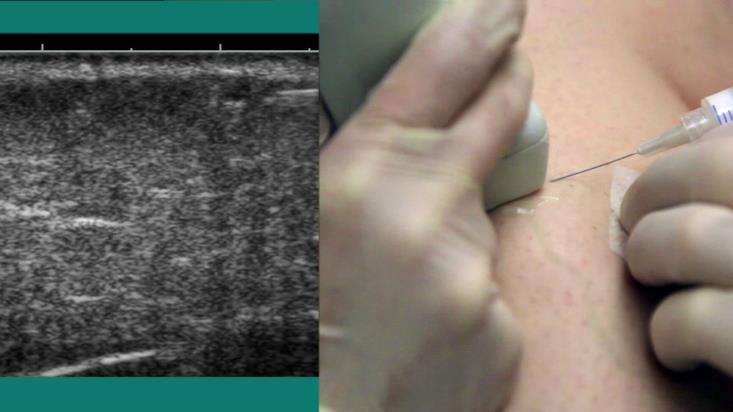 visually or by ultrasound that are contributing Laser