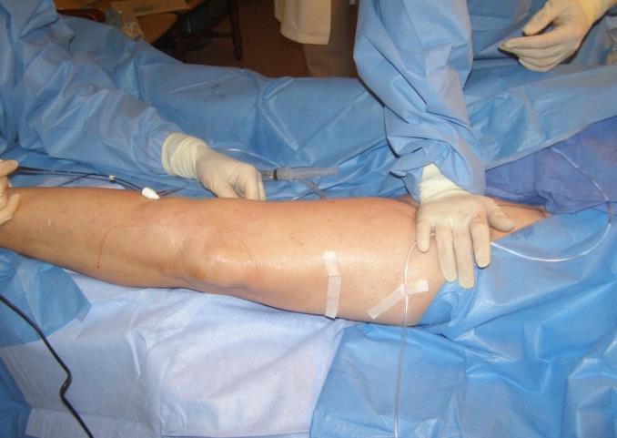 Endovenous Thermal Ablation - Complications Intra-operative Complications Technical Challenges Difficulty advancing