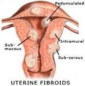 Uterine Fibroids = benign (noncancerous)