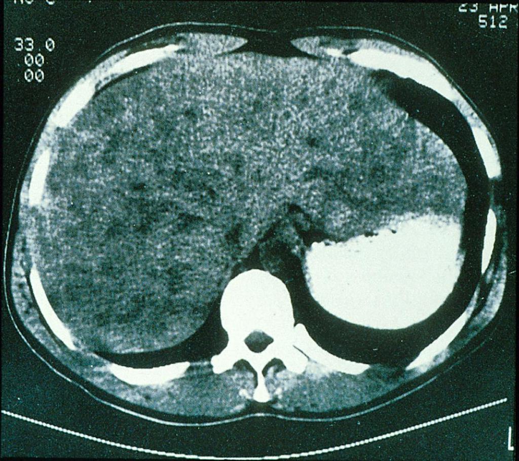 Liver scan with focal