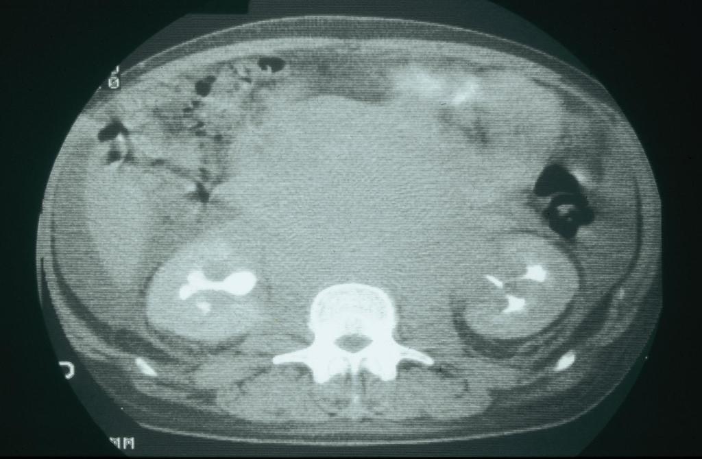 Abdominal CT Scan of a Patient