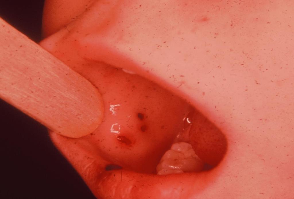 A child with bleeding in the mouth